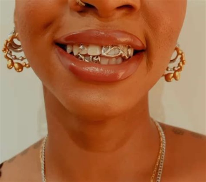 Braces That Look Like Grills: A Unique Fashion Statement